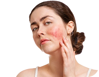 Acne, Redness, Pigmentation & Skin Texture