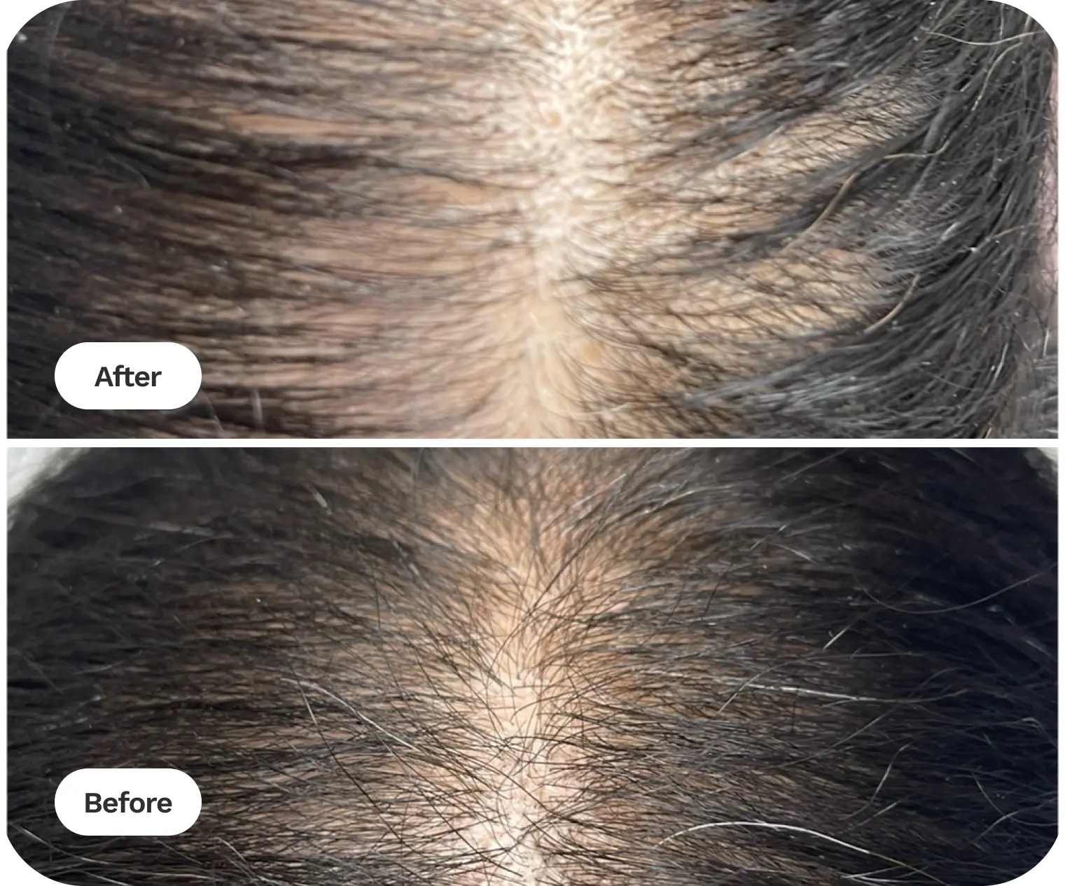 Prp Hair Restoration