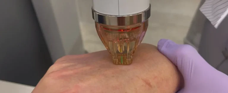 RF Microneedling