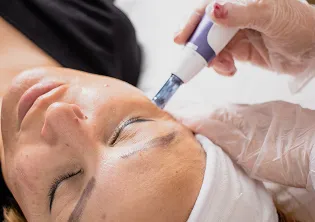 Microneedling