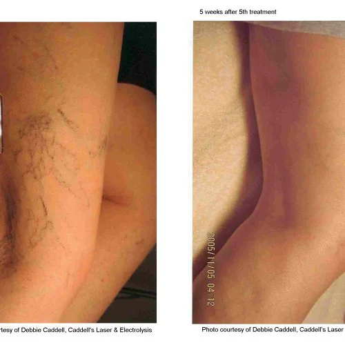 Laser Vascular Lesion Removal Ba