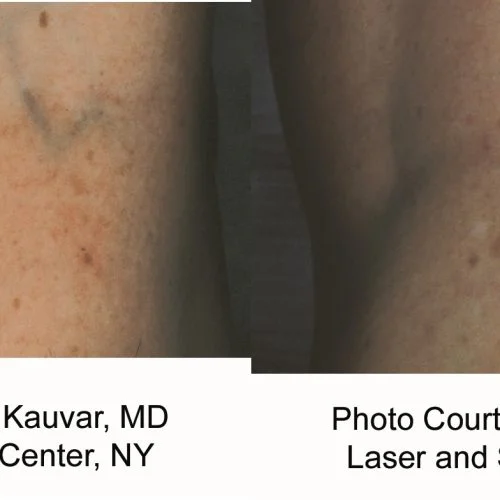 Laser Vascular Lesion Removal Ba