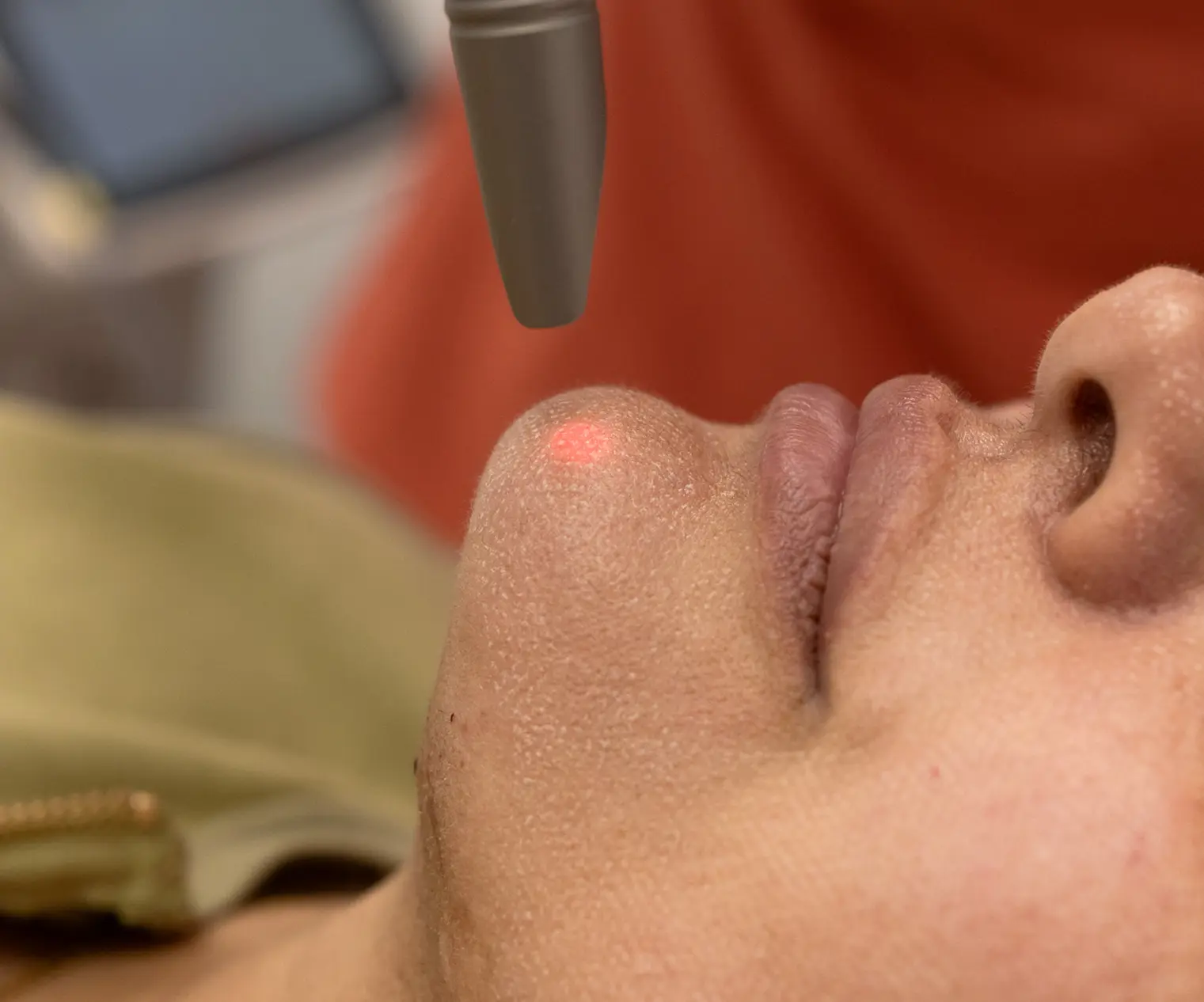 Skin Resurfacing