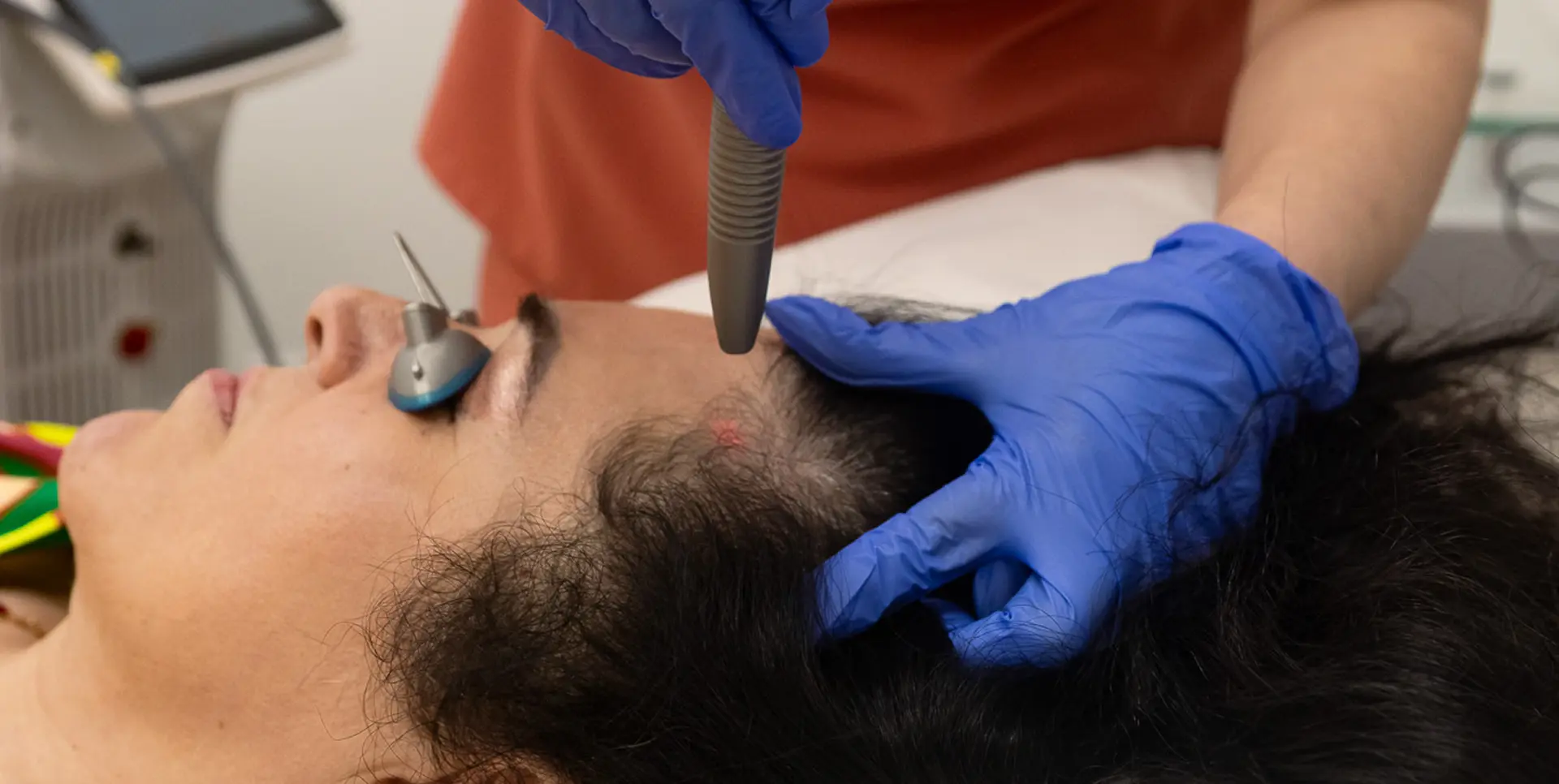 Hairline Laser Procedure
