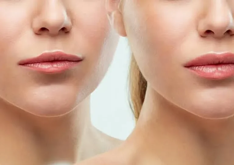Lip Augmentation