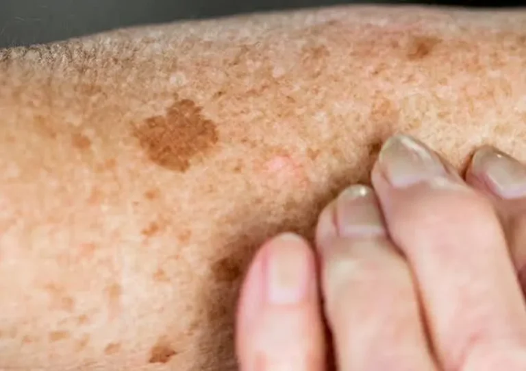 Age Spot