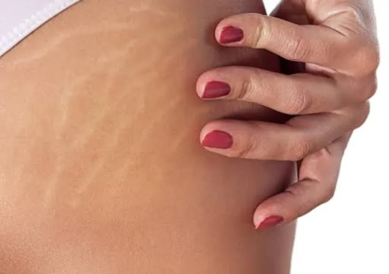 Stretch Mark