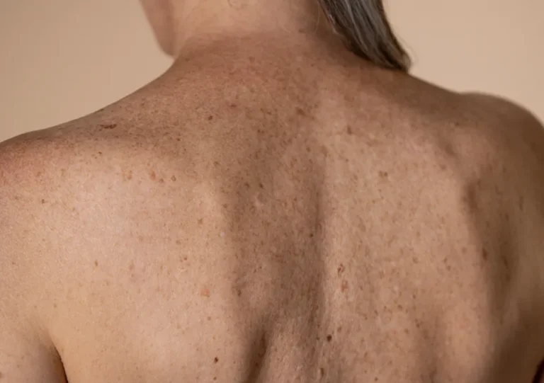 Sun Damage