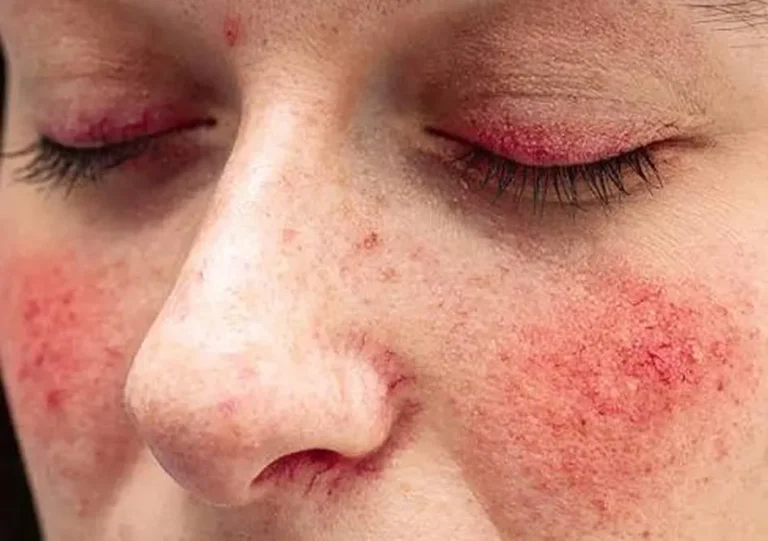 Rosacea Treatment