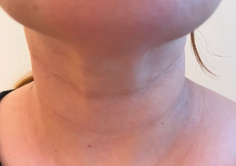 Neck Lift