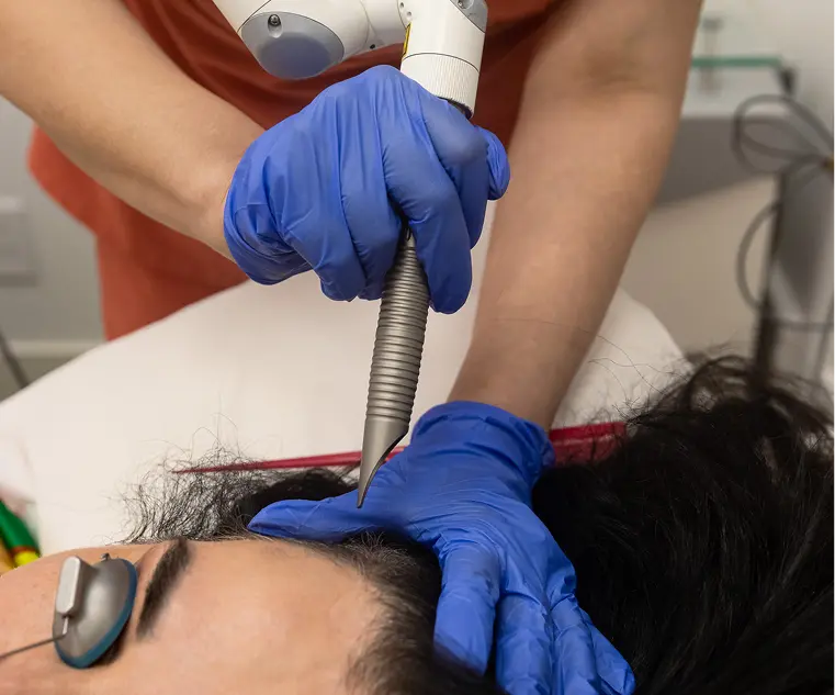 Scalp Laser Treatment