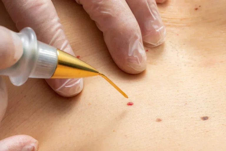 Hemangiomas Removal