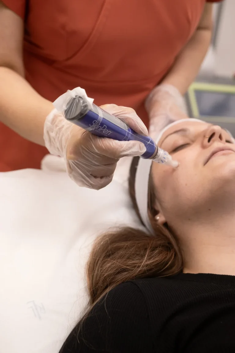 Microneedling with Rose Exosomes