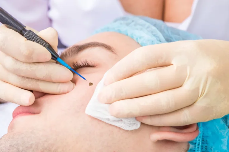 Mole / Skin Tag Removal